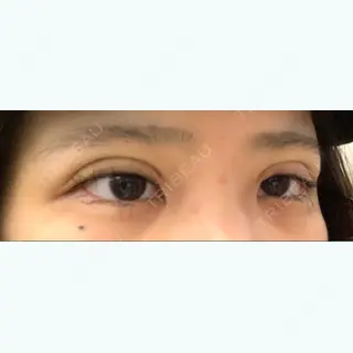 0日目の経過画像（2枚目）
