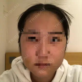 5日目の経過画像（1枚目）
