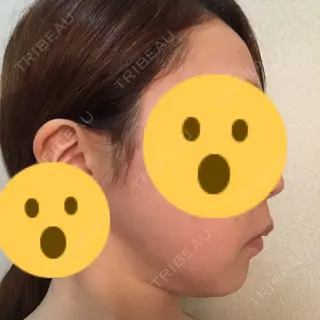 17日目の経過画像（2枚目）