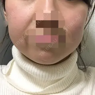 11日目の経過画像（2枚目）