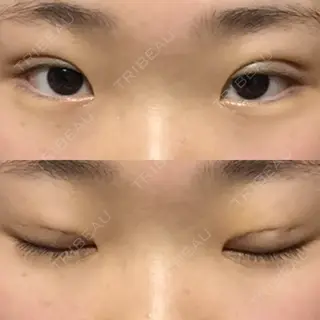 4日目の経過画像（1枚目）
