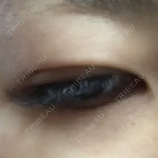 1日目の経過画像（2枚目）