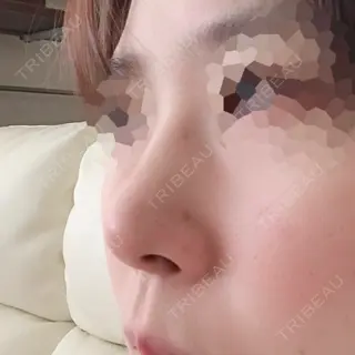 3日目の経過画像（2枚目）