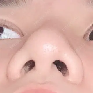 5日目の経過画像（2枚目）