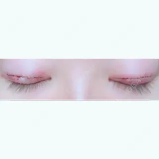 1日目の経過画像（3枚目）
