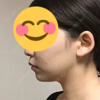 20日目の経過画像（1枚目）