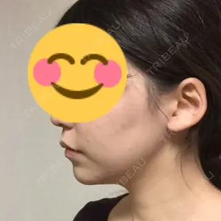 33日目の経過画像（1枚目）