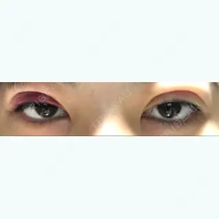 1日目の経過画像（1枚目）