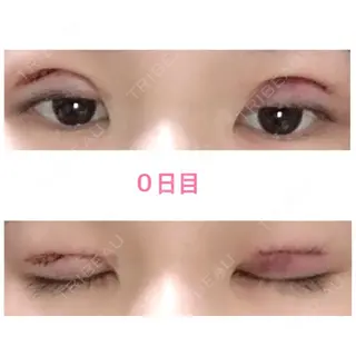0日目の経過画像（1枚目）