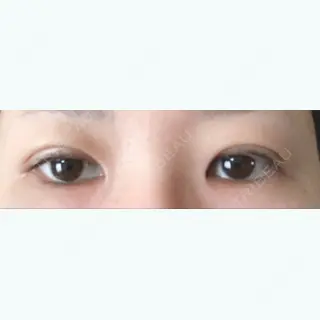 14日目の経過画像（1枚目）