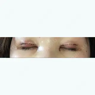 3日目の経過画像（2枚目）