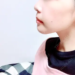 41日目の経過画像（1枚目）