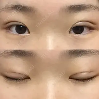 5日目の経過画像（1枚目）