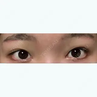 25日目の経過画像（1枚目）