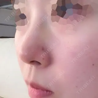 5日目の経過画像（2枚目）