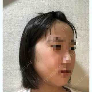 8日目の経過画像（3枚目）