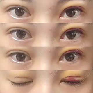 4日目の経過画像（1枚目）