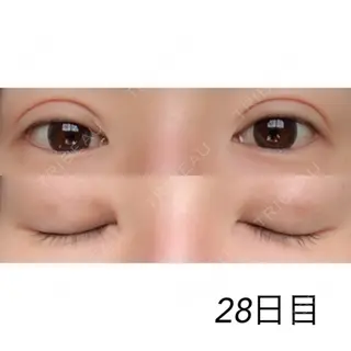 28日目の経過画像（1枚目）