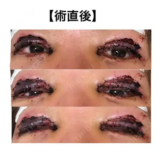 0日目の経過画像（2枚目）