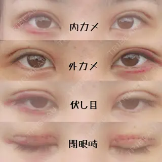 3日目の経過画像（1枚目）