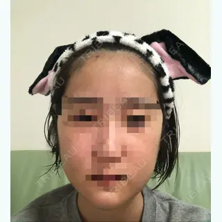 9日目の経過画像（1枚目）