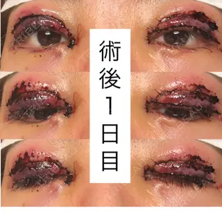 1日目の経過画像（1枚目）