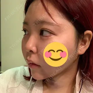 0日目の経過画像（2枚目）
