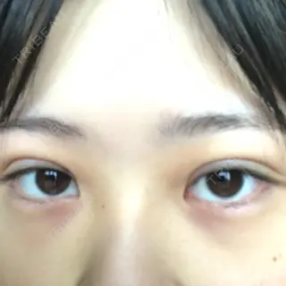 2日目の経過画像（3枚目）