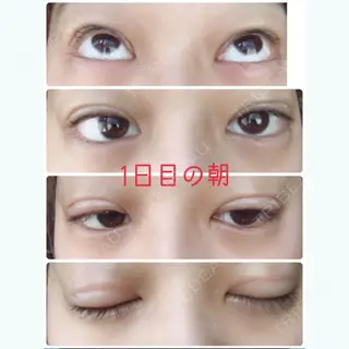 1日目の経過画像（1枚目）