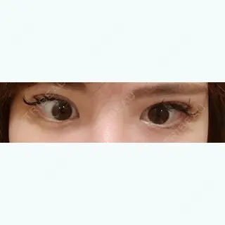 70日目の経過画像（1枚目）
