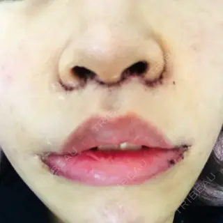 1日目の経過画像（1枚目）