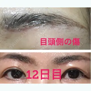 12日目の経過画像（1枚目）