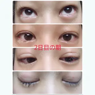 2日目の経過画像（1枚目）