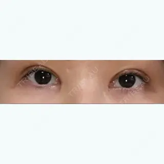 7日目の経過画像（1枚目）