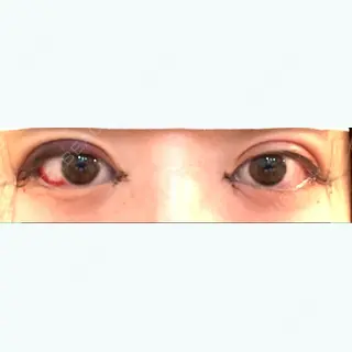 0日目の経過画像（1枚目）