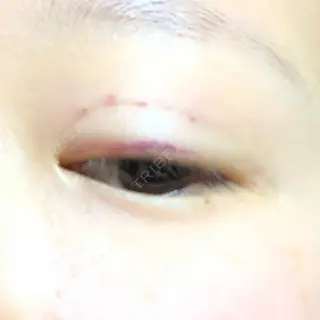 1日目の経過画像（2枚目）