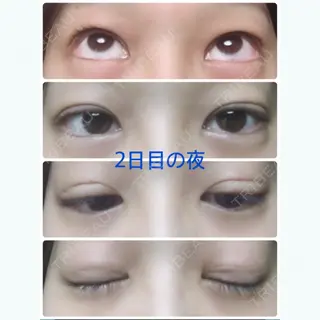 2日目の経過画像（1枚目）