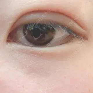5日目の経過画像（1枚目）