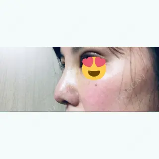 11日目の経過画像（2枚目）