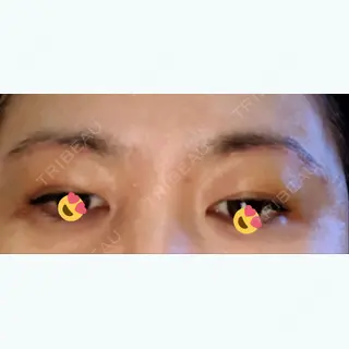 12日目の経過画像（3枚目）
