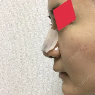 2日目の経過画像（3枚目）