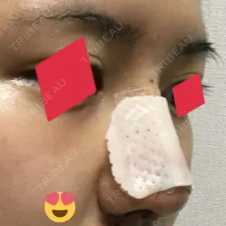3日目の経過画像（3枚目）
