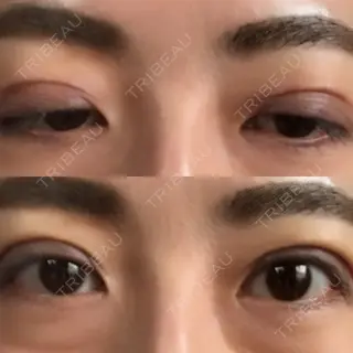 3日目の経過画像（1枚目）