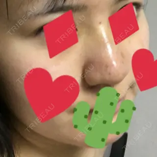 4日目の経過画像（2枚目）