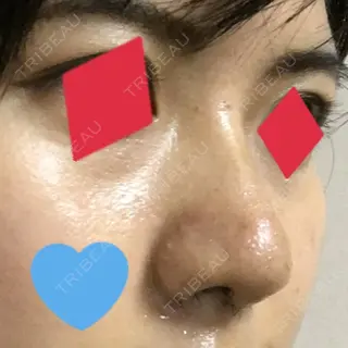 6日目の経過画像（3枚目）