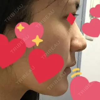 8日目の経過画像（3枚目）