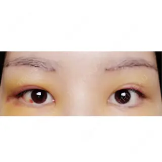 5日目の経過画像（1枚目）