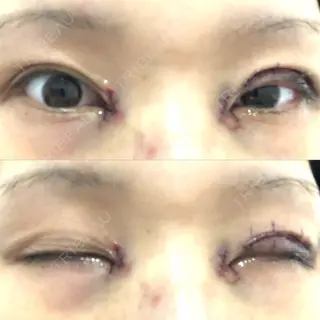0日目の経過画像（1枚目）