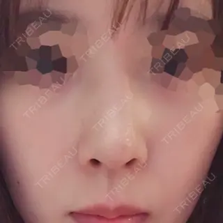 9日目の経過画像（1枚目）
