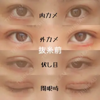 6日目の経過画像（1枚目）